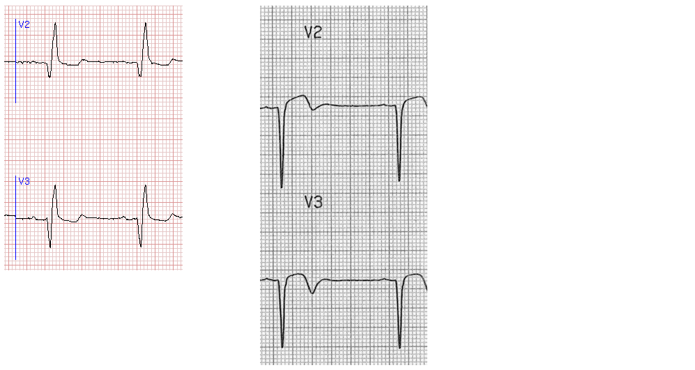 Подъем st v4. Подъем сегмента St на ЭКГ. STEMI на ЭКГ.