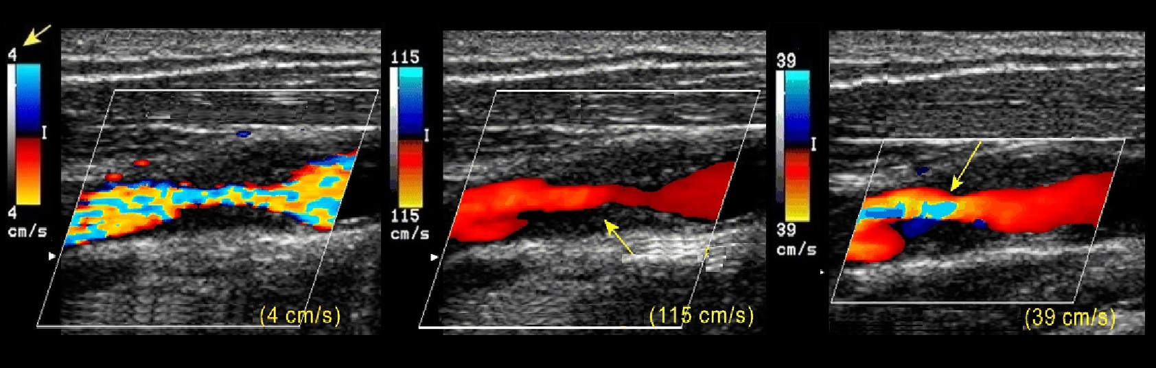 Доплер нижних. Ультразвуковое компрессионное дуплексное ангиосканирование. Ультразвуковая допплерография артерий нижних конечностей. Ультразвуковая допплерография вен нижних конечностей. Ультразвуковое цветное дуплексное сканирование тромбоз.