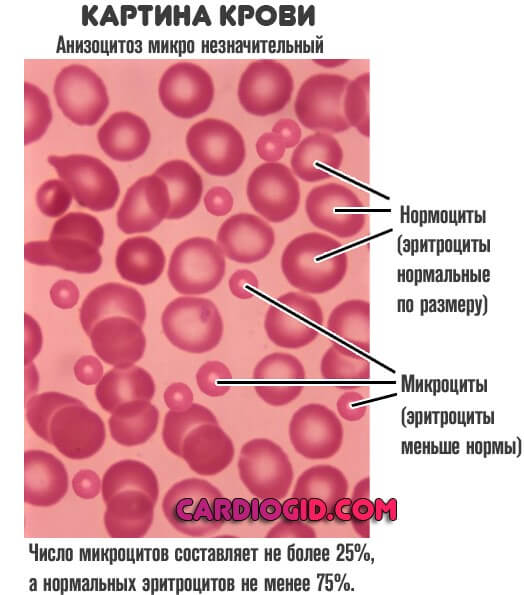 Анемия и эритроциты в крови. Показатели при микроцитарной анемии. Макроцитарные нормохромные анемия. Железодефицитная анемия картина крови. Анизоцитоз микро незначительный эритроцитов.